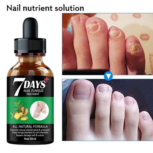 Toenail Fungus Treatment Serum - Natural Tea Tree & Oregano Oil | Nail Repair Solution