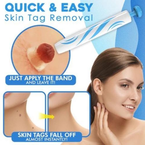 Skin Tag Remover Kit - Natural Safe Rubber Band Method