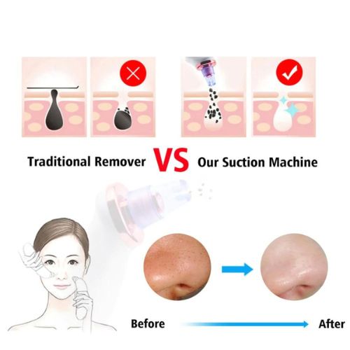Blackhead Removal Suction Tool - Electric Pore Vacuum Cleaner - TradixPro