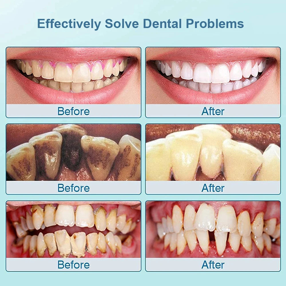 Professional Ultrasonic Tooth Cleaner & Plaque Remover - At-Home Deep Cleaning - TradixPro